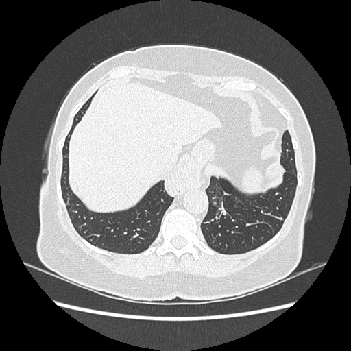 Adenocarcinoma in situ of lung (Radiopaedia 38685-40829 B 187).png