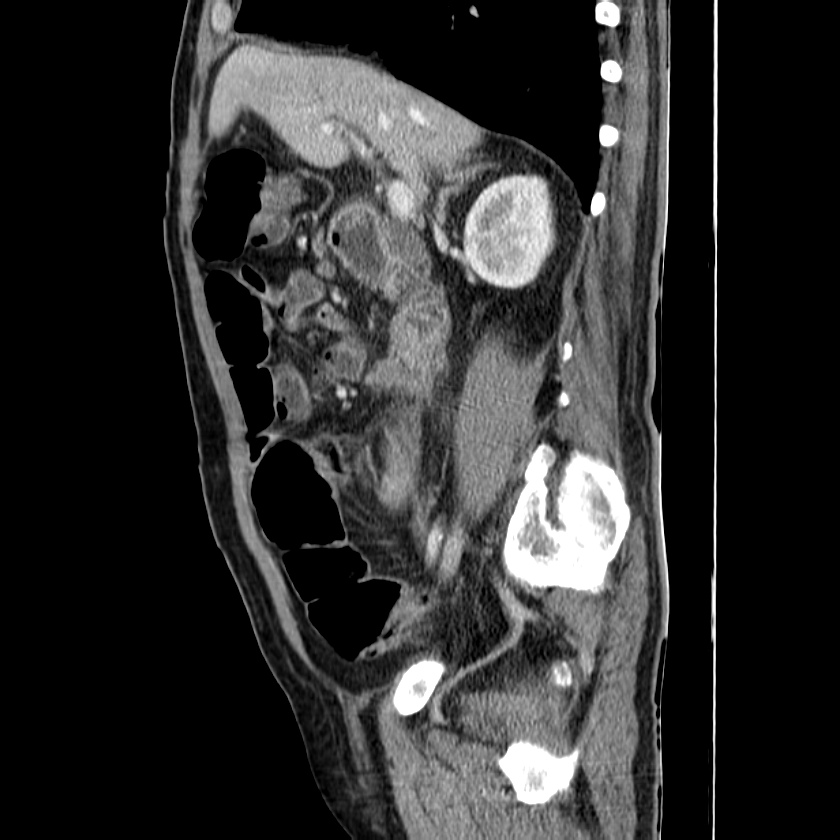 Adenocarcinoma of colon with entero-colic fistula (Radiopaedia 22832-22852 Sagittal C+ portal venous phase 25).jpg