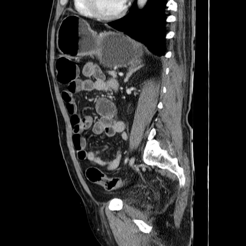 Adenocarcinoma of colon with entero-colic fistula (Radiopaedia 22832-22852 Sagittal C+ portal venous phase 41).jpg
