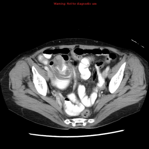 Adenocarcinoma of the colon (Radiopaedia 8191-9039 Axial liver window 64).jpg