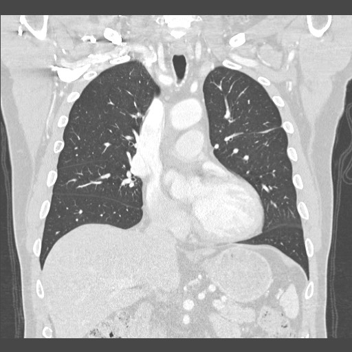 Adenocarcinoma of the lung (Radiopaedia 59871-67325 Coronal lung window 24).jpg