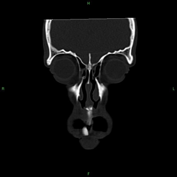 File:Adenoid cystic carcinoma of hard palate (Radiopaedia 26137-26273 Coronal bone window 3).jpg