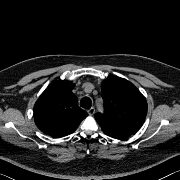 Adenoid cystic carcinoma of the trachea (Radiopaedia 49042-54137 Axial non-contrast 79).jpg