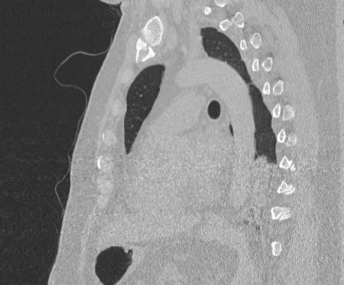 Adenoid cystic carcinoma of the trachea (Radiopaedia 49042-54137 Sagittal lung window 274).jpg