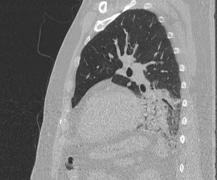Adenoid cystic carcinoma of the trachea (Radiopaedia 49042-54137 Sagittal lung window 319).jpg
