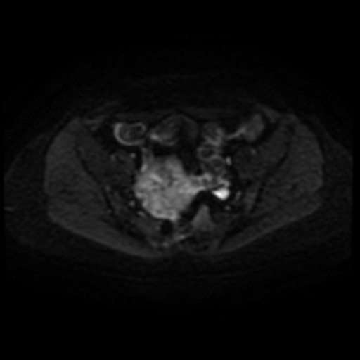 File:Adenoma malignum of cervix (Radiopaedia 66441-75705 Axial DWI 31).jpg