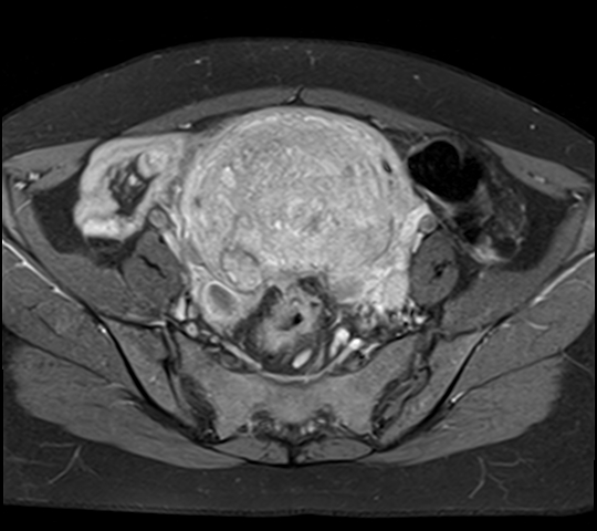 File:Adenomyosis - ovarian endometriomas (Radiopaedia 67031-76350 Axial T1 C+ fat sat 10).jpg
