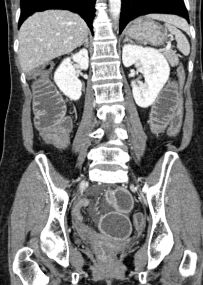 Adhesional small bowel obstruction (Radiopaedia 48397-53305 Coronal C+ portal venous phase 226).jpg