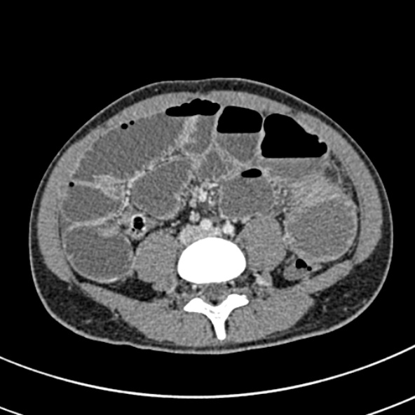 Adhesional small bowel obstruction (Radiopaedia 52107-57980 Axial C+ portal venous phase 77).jpg
