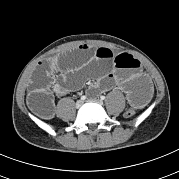 Adhesional small bowel obstruction (Radiopaedia 52107-57980 Axial C+ portal venous phase 82).jpg