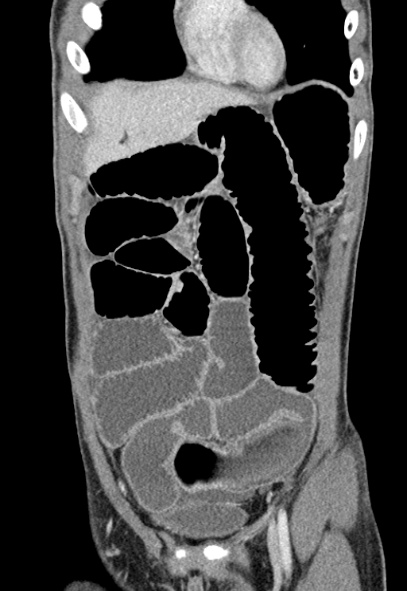 Adhesional small bowel obstruction (Radiopaedia 52107-57980 Coronal C+ portal venous phase 17).jpg