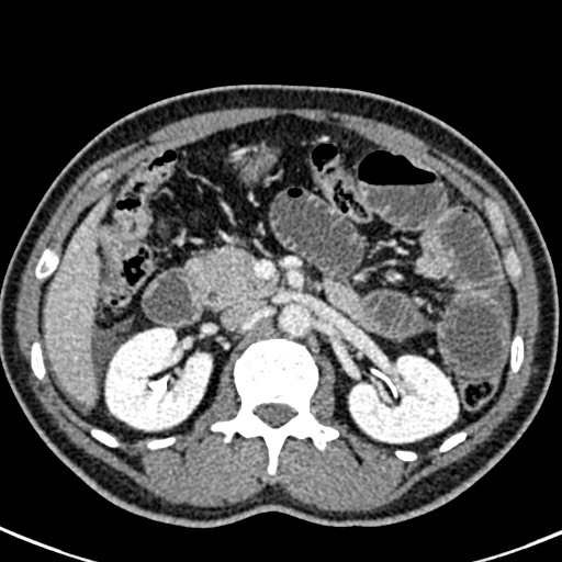 Adhesional small bowel obstruction (Radiopaedia 58900-66131 Axial C+ portal venous phase 19).jpg