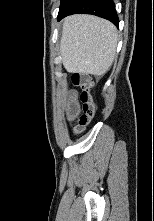 Adhesional small bowel obstruction (Radiopaedia 58900-66131 Sagittal C+ portal venous phase 34).jpg