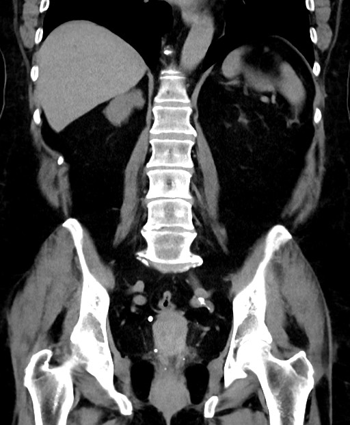 Adrenal cortical carcinoma (Radiopaedia 64017-72769 Coronal C+ delayed 41).jpg