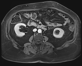 Adrenal cortical carcinoma (Radiopaedia 64017-72770 K 52).jpg