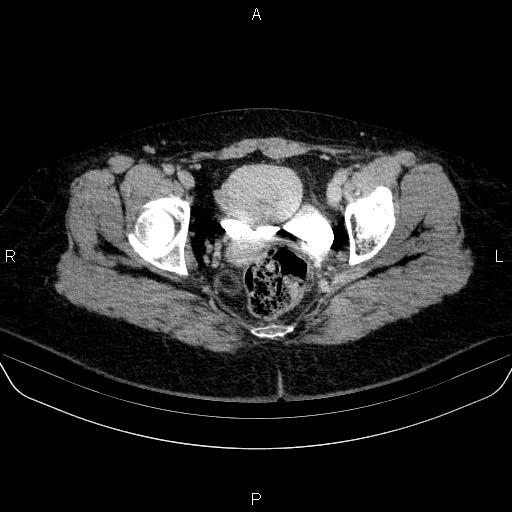 Adrenal cortical carcinoma (Radiopaedia 84882-100379 Axial C+ delayed 89).jpg