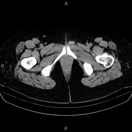 File:Adrenal cortical carcinoma (Radiopaedia 84882-100379 Axial non-contrast 101).jpg