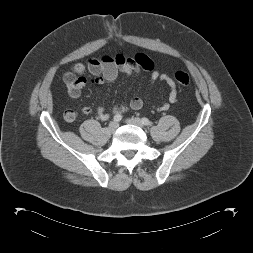 Adrenal cyst (Radiopaedia 45625-49776 Axial C+ portal venous phase 68).png