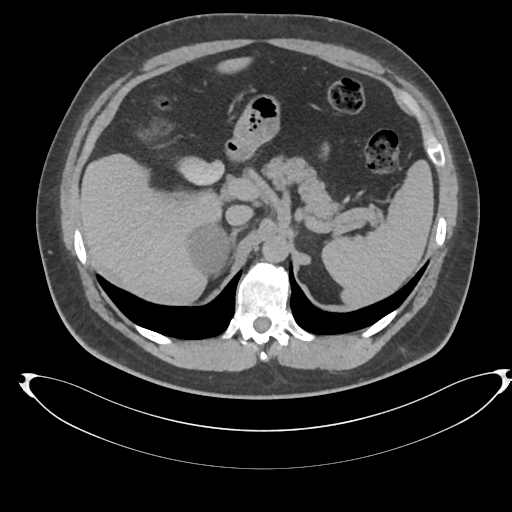 Adrenal cyst (Radiopaedia 45625-49778 AXIAL THICK 15 min 17).png