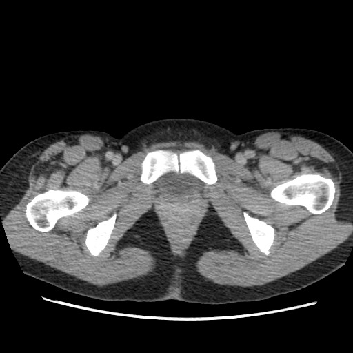 Adrenal cyst (Radiopaedia 64869-73813 Axial C+ portal venous phase 81).jpg