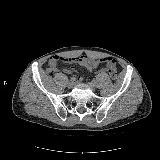 File:Adrenal cystic lymphangioma (Radiopaedia 83161-97534 Axial non-contrast 73).jpg