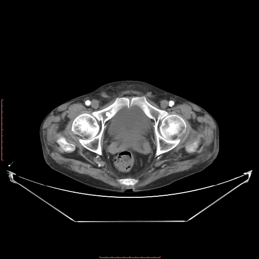 File:Adrenal hemangioma (Radiopaedia 68923-78668 Axial C+ arterial phase 69).jpg