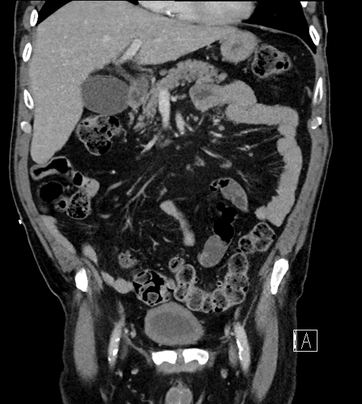 Adrenal lymphoma (Radiopaedia 73730-84529 Coronal C+ portal venous phase 29).jpg