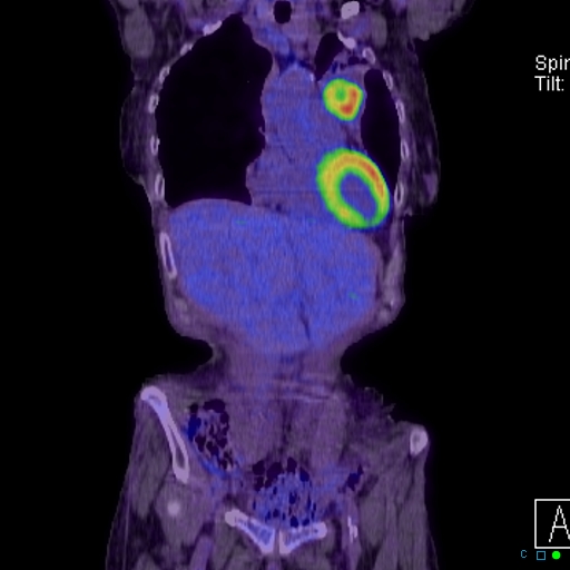 File:Adrenal metastasis from small cell lung cancer (Radiopaedia 19133-19109 Coronal 5).jpg