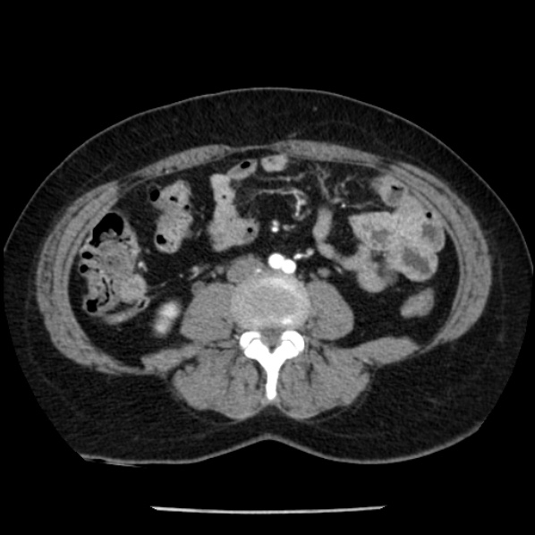 Adrenal myelolipoma (Radiopaedia 43401-46759 Axial C+ arterial phase 59).jpg
