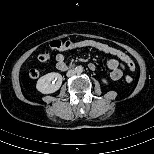 Adrenal myelolipoma (Radiopaedia 82742-96986 Axial renal excretory phase 81).jpg