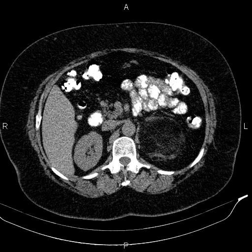 Adrenal myelolipoma (Radiopaedia 84319-99617 Axial With oral contrast 81).jpg