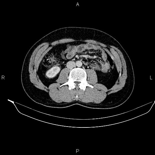 File:Adrenal myelolipoma (Radiopaedia 87794-104246 Axial renal cortical phase 55).jpg