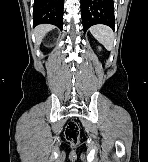 Adrenal myelolipoma (Radiopaedia 87794-104246 Coronal renal cortical phase 54).jpg