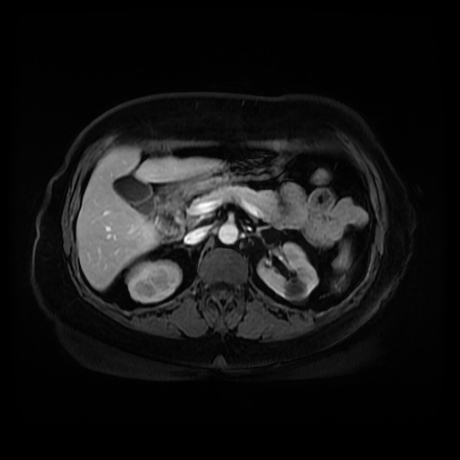 Adrenal myelolipoma - MRI (Radiopaedia 83249-97646 T1 fat sat arterial phase 37).jpg