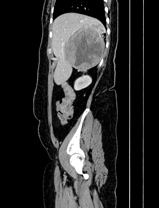 Adrenocortical carcinoma (Radiopaedia 87281-103569 Sagittal C+ portal venous phase 47).jpg