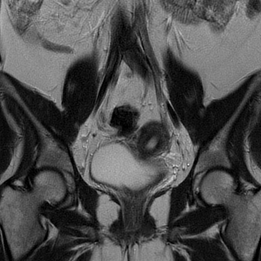 File:Adult granulosa cell tumor of the ovary (Radiopaedia 64991-73953 Coronal T2 12).jpg