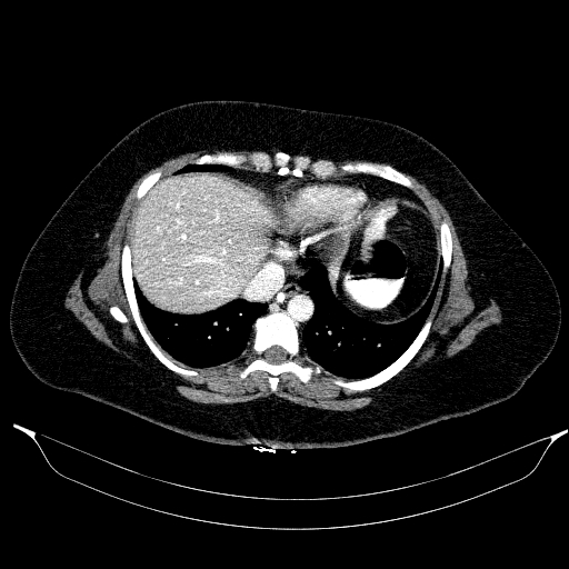 File:Afferent loop syndrome - secondary to incarcerated trocar site hernia (Radiopaedia 82959-97305 Axial C+ portal venous phase 25).jpg