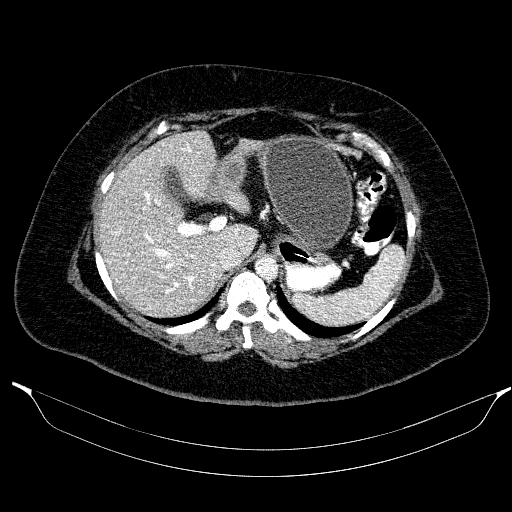 Afferent loop syndrome - secondary to incarcerated trocar site hernia (Radiopaedia 82959-97305 Axial C+ portal venous phase 57).jpg