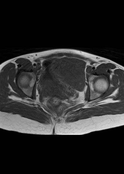 File:Aggressive angiomyxoma of the pelvis and perineum (Radiopaedia 59162-66479 T1 12).jpg