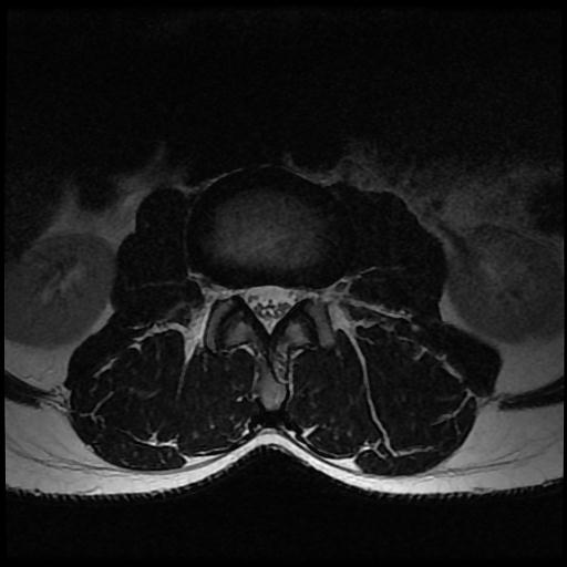 File:Aggressive vertebral hemangioma with pathological fracture (Radiopaedia 69528-79411 Axial T2 9).jpg