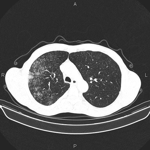 File:Air bronchogram in pneumonia (Radiopaedia 85719-101512 Axial lung window 23).jpg