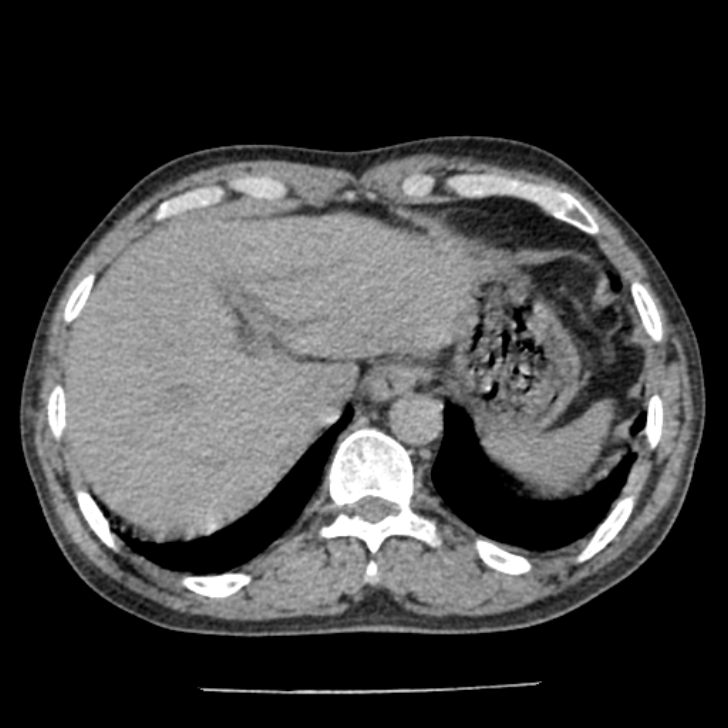 Airway foreign body in adult (Radiopaedia 85907-101779 Axial liver window 179).jpg