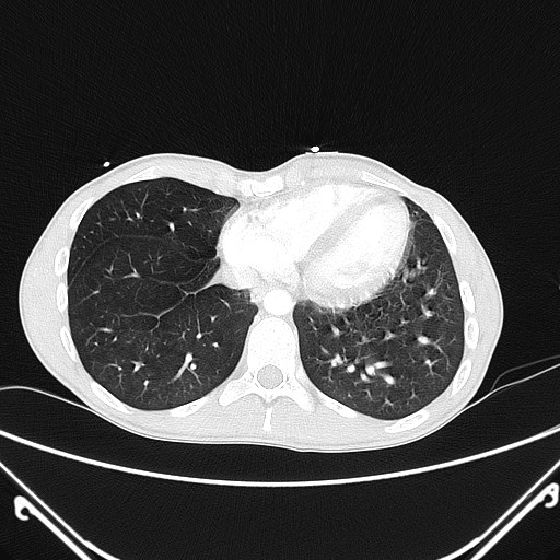 File:Alagille syndrome with pulmonary hypertension (Radiopaedia 49384-54980 Axial lung window 6).jpg