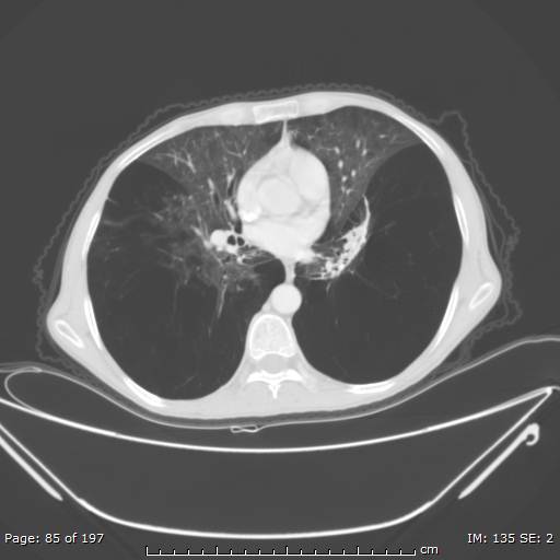 Alpha-1-antitrypsin deficiency (Radiopaedia 50561-55987 Axial lung window 36).jpg
