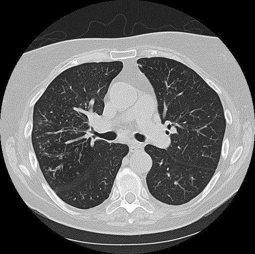 File:Alpha-1-antitrypsin deficiency (Radiopaedia 72058-82557 Axial lung window 31).jpg