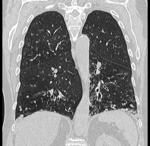 Alpha-1-antitrypsin deficiency (Radiopaedia 72058-82557 Coronal lung window 61).jpg