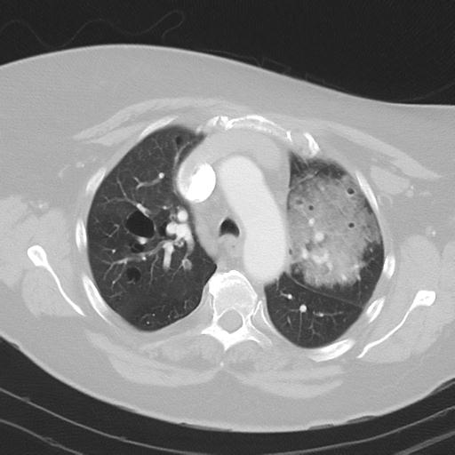 Alveolar hemorrhage and possible lymphocytic interstitial pneumonitis in systemic lupus erythematosus (Radiopaedia 28582-28839 Axial lung window 16).jpg