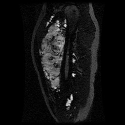 Alveolar soft part sarcoma (Radiopaedia 64501-73678 D 89).jpg