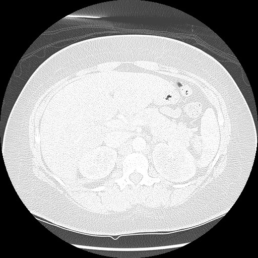 Alveolar soft part sarcoma - right leg (Radiopaedia 59432-67091 Axial lung window 116).jpg