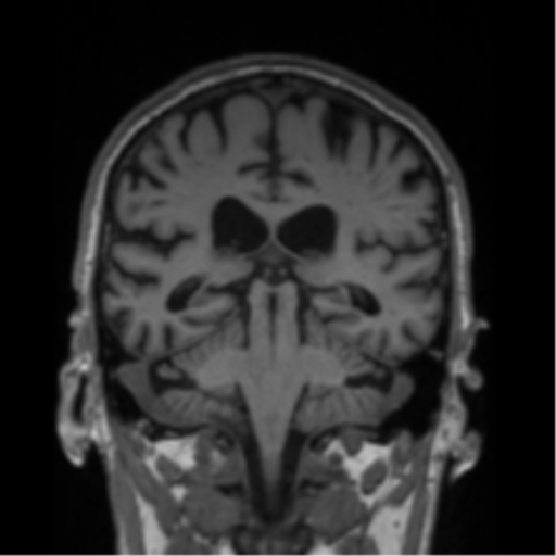 Alzheimer's disease- with Gerstmann syndrome and dressing apraxia (Radiopaedia 54882-61150 Coronal T1 36).png